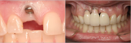before-and-after-implants