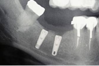 dental-implant-xray