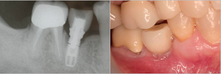 implant-photo-and-xray