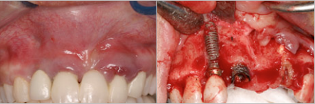 overly-graphic-implant-photo