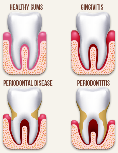 Ask a Periodontist - How Can Gum Disease Harm Your Teeth and Jawbone?
